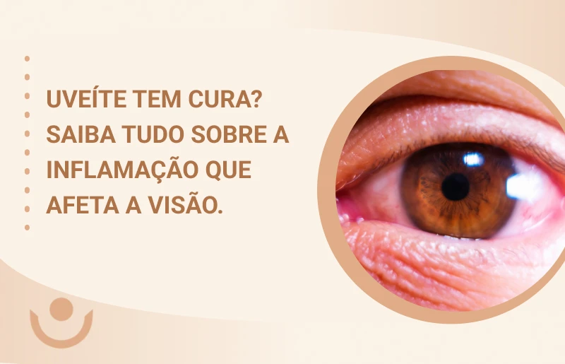 uveite tem cura saiba tudo sobre a inflamação que afeta a visão